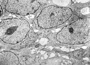 F,12y. | medulloblastoma F,12y. | medulloblastoma